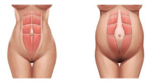 Diástase abdominal presente após gestações.