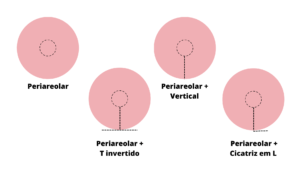 Os cortes em mastopexia são variáveis e depende do tipo de mama de cada mulher.