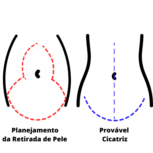 Abdominoplastia em âncora é muito procurada pelas pacientes pós bariátricas.