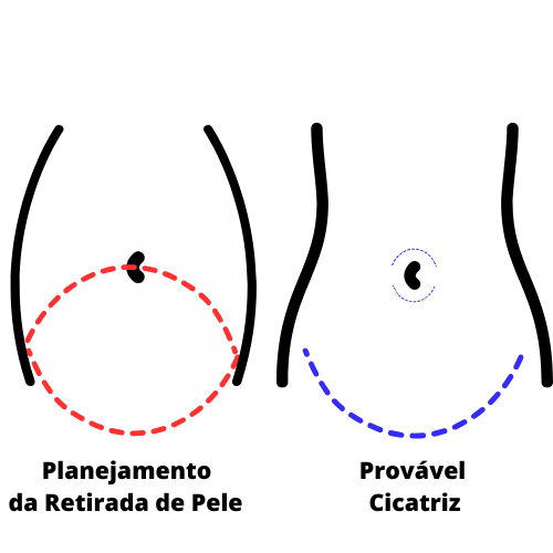 A miniabdominoplastia tende a ser o tipo mais desejado pelas mulheres.