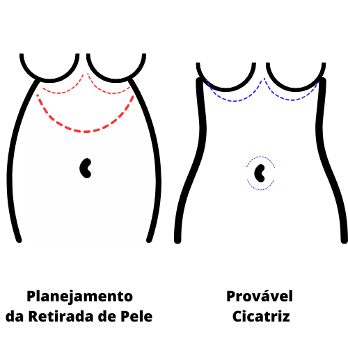 Abdominoplastia reversa é um tipo incomum de ser realizada.