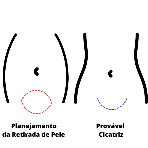 A miniabdominoplastia tende a ser o tipo mais desejado pelas mulheres.