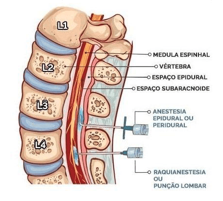 Anestesias regionais: raquianestesia e anestesia epidural.